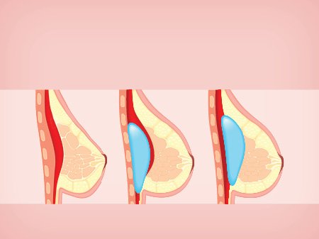 If you're considering breast augmentation, be sure to discuss breast implant options with your plastic surgeon.